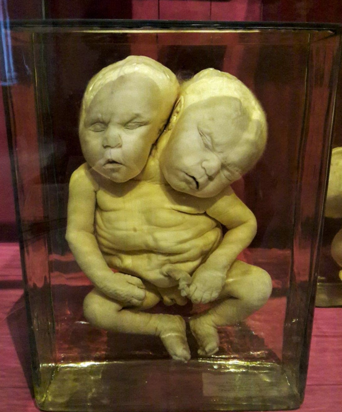 Twins with two heads.jpg